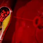 Tiché príznaky na koži, očiach a šľachách: Ako rozpoznať vysoký cholesterol včas?