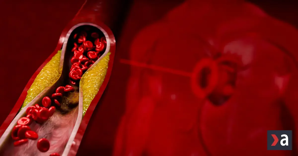 Tiché príznaky na koži, očiach a šľachách: Ako rozpoznať vysoký cholesterol včas?